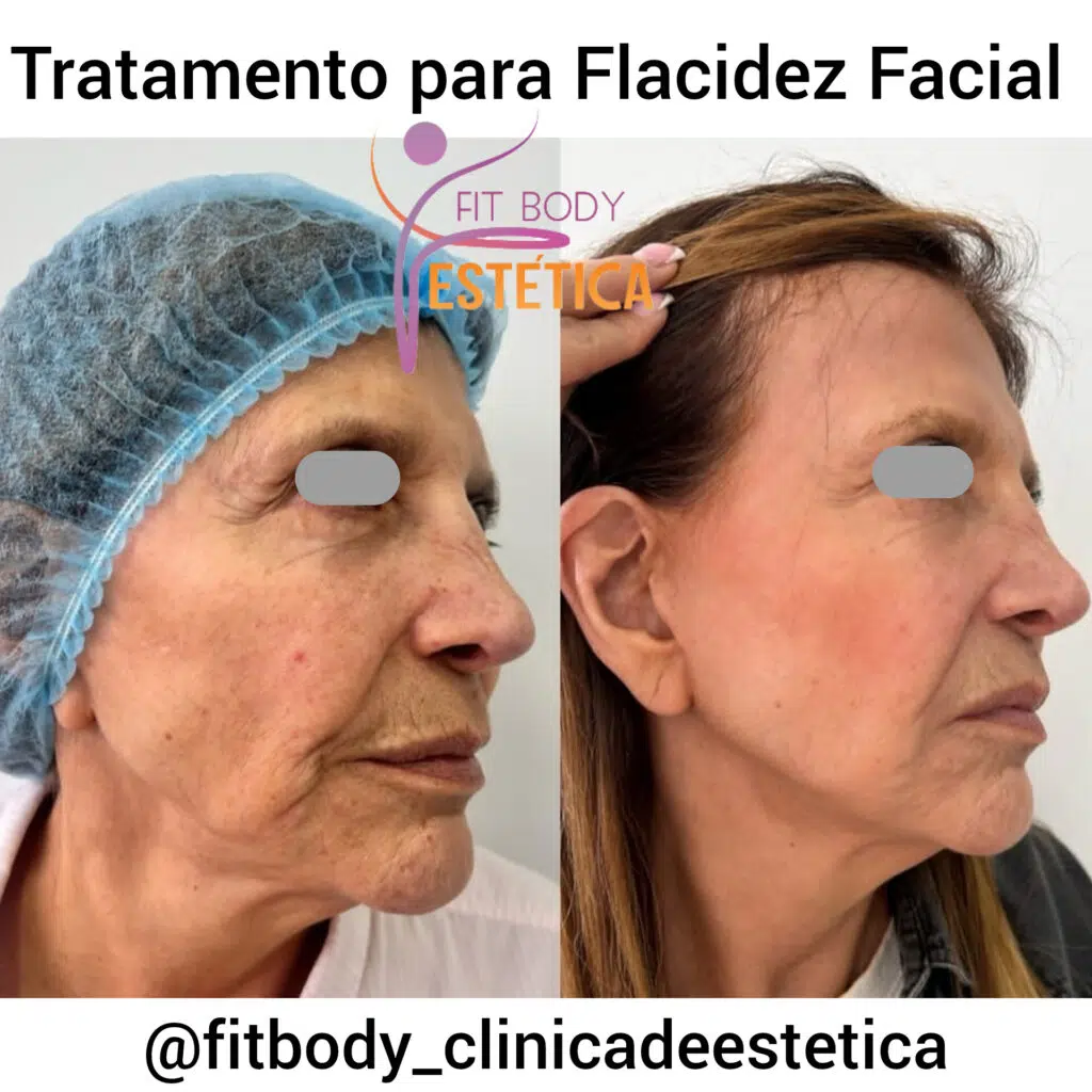 5 ideias de títulos:
1. Flacidez Facial: Entenda as Causas e Descubra os Tratamentos Mais Eficazes
2. Guia Completo: Como Combater a Flacidez da Pele do Rosto
3. Bioestimuladores de Colágeno: A Revolução no Tratamento da Flacidez
4. Cuidados Essenciais para Prevenir e Tratar a Flacidez Facial
5. Procedimentos Cirúrgicos para Flacidez Severa: O Que Você Precisa Saber