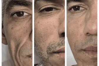 5 ideias de títulos:
1. Flacidez Facial: Entenda as Causas e Descubra os Tratamentos Mais Eficazes
2. Guia Completo: Como Combater a Flacidez da Pele do Rosto
3. Bioestimuladores de Colágeno: A Revolução no Tratamento da Flacidez
4. Cuidados Essenciais para Prevenir e Tratar a Flacidez Facial
5. Procedimentos Cirúrgicos para Flacidez Severa: O Que Você Precisa Saber