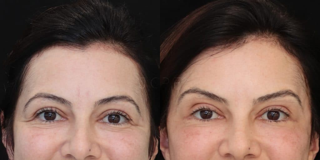 5 ideias de títulos:
1. Flacidez Facial: Entenda as Causas e Descubra os Tratamentos Mais Eficazes
2. Guia Completo: Como Combater a Flacidez da Pele do Rosto
3. Bioestimuladores de Colágeno: A Revolução no Tratamento da Flacidez
4. Cuidados Essenciais para Prevenir e Tratar a Flacidez Facial
5. Procedimentos Cirúrgicos para Flacidez Severa: O Que Você Precisa Saber