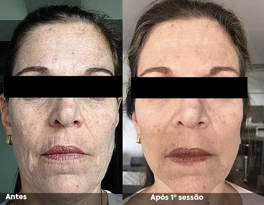flacidez facial