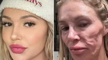 5 ideias de títulos:
1. Flacidez Facial: Entenda as Causas e Descubra os Tratamentos Mais Eficazes
2. Guia Completo: Como Combater a Flacidez da Pele do Rosto
3. Bioestimuladores de Colágeno: A Revolução no Tratamento da Flacidez
4. Cuidados Essenciais para Prevenir e Tratar a Flacidez Facial
5. Procedimentos Cirúrgicos para Flacidez Severa: O Que Você Precisa Saber