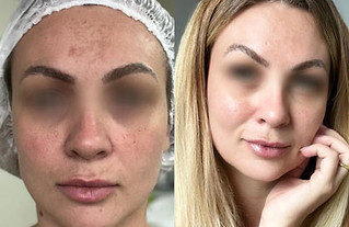 Laser Lavieen: O Guia Definitivo para uma Pele Renovada