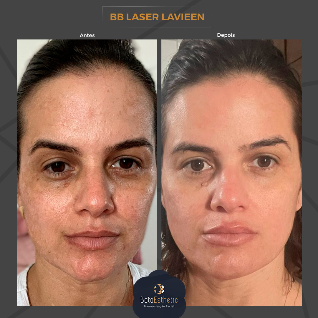 Tudo Sobre o Preço e Indicações do Laser Lavieen