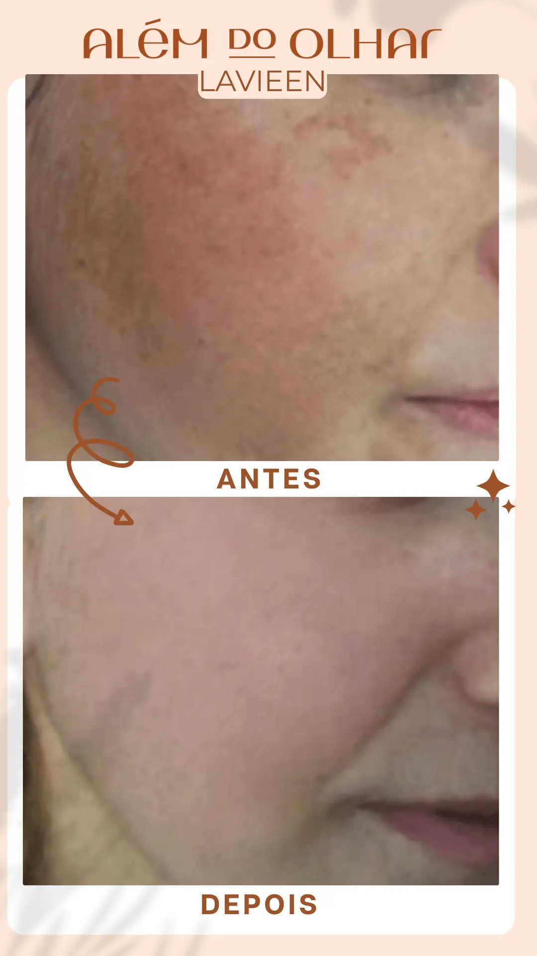 Laser Lavieen: O Guia Definitivo para uma Pele Renovada