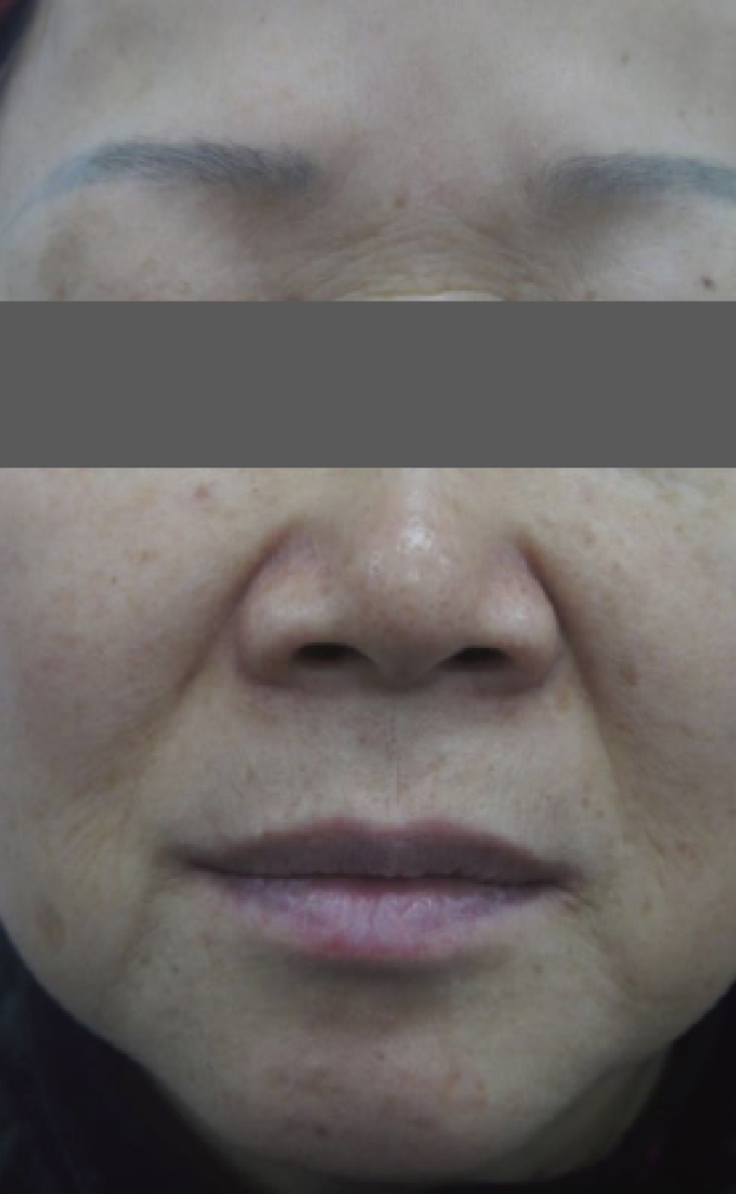 Tudo Sobre o Preço e Indicações do Laser Lavieen