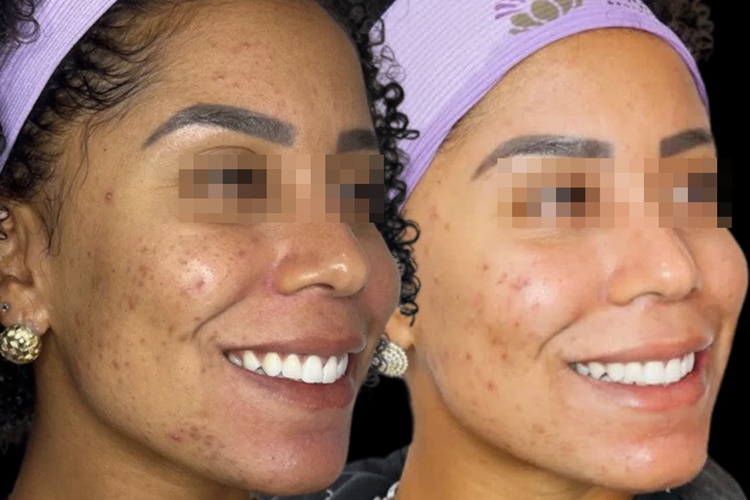 Descubra o Efeito BB Glow com o Laser Lavieen