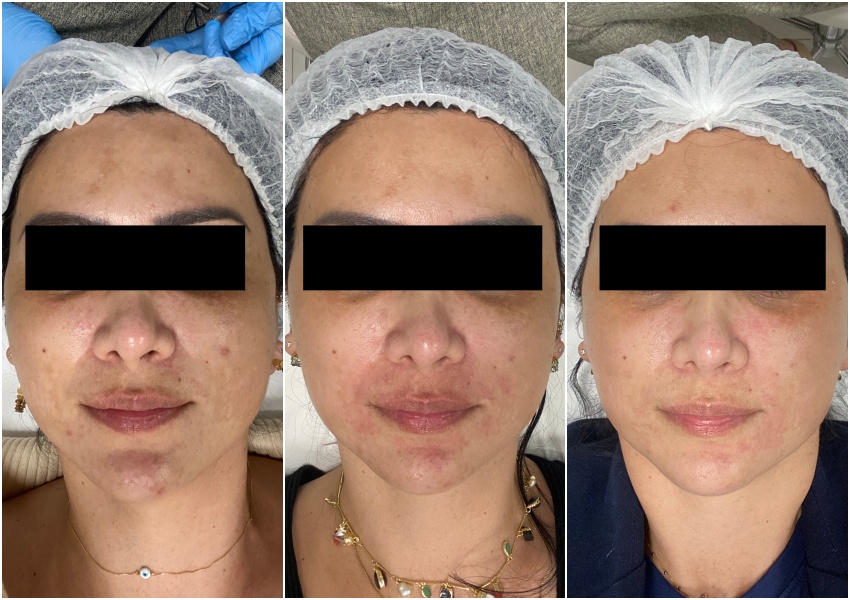 Lavieen vs. Outros Lasers: Qual a Melhor Opção para Você?