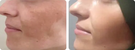 Cuidados Essenciais Pós-Tratamento com Laser Lavieen