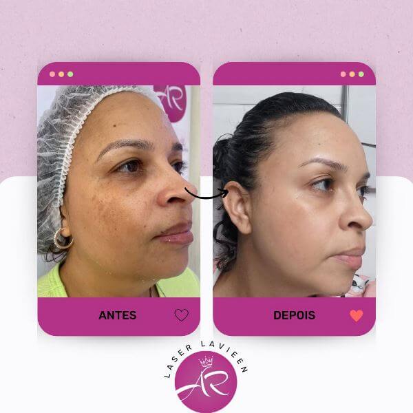 Tudo Sobre o Preço e Indicações do Laser Lavieen