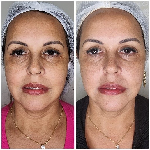 Laser Lavieen: O Guia Definitivo para uma Pele Renovada