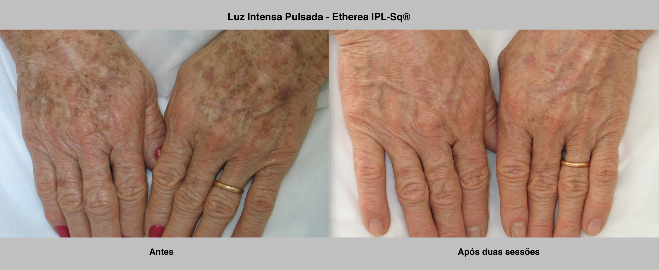 Luz Pulsada vs. Laser: Qual a Melhor Opção para Você?