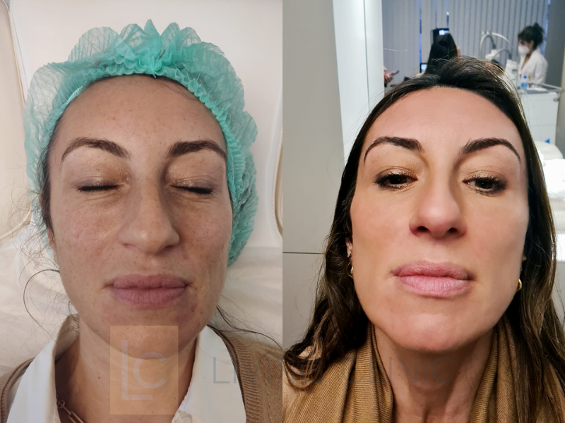 Como a Luz Pulsada Trata Manchas e Vasos Sanguíneos