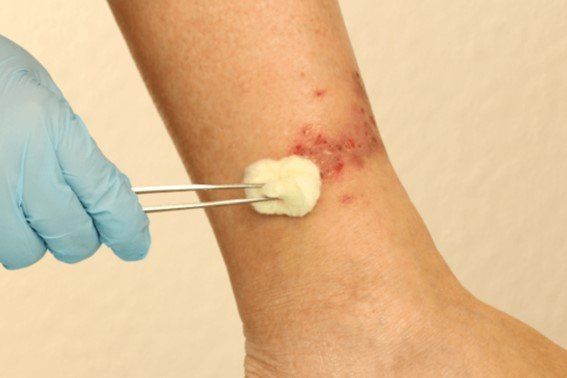 Prevenção de Úlceras: Estilo de Vida e Cuidados Essenciais