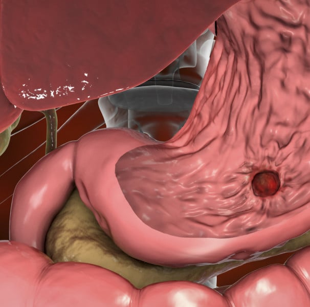 Diagnóstico de Úlceras: Exames e Procedimentos