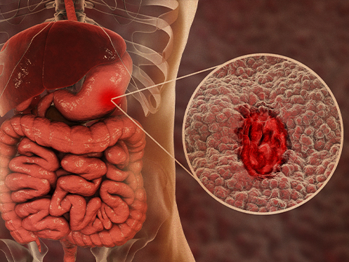 Tipos de Úlceras: Da Pele ao Estômago