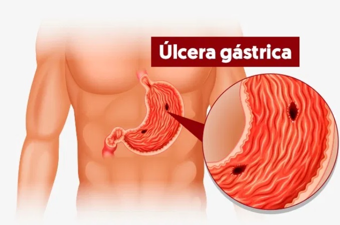 Como Tratar Úlceras: Opções e Recomendações Médicas