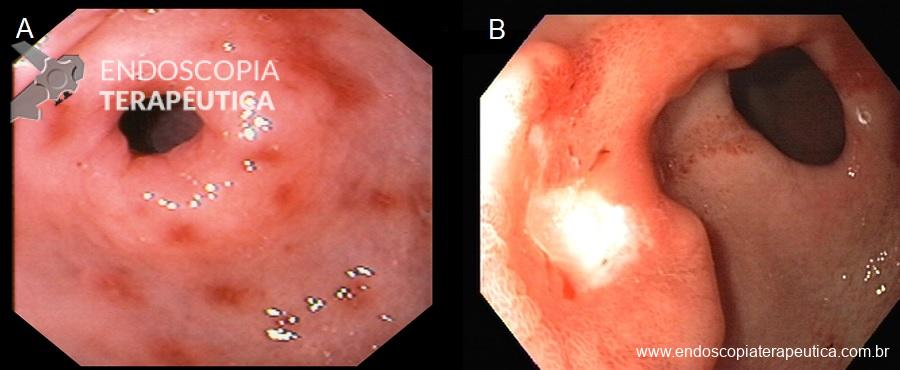 Tipos de Úlceras: Da Pele ao Estômago
