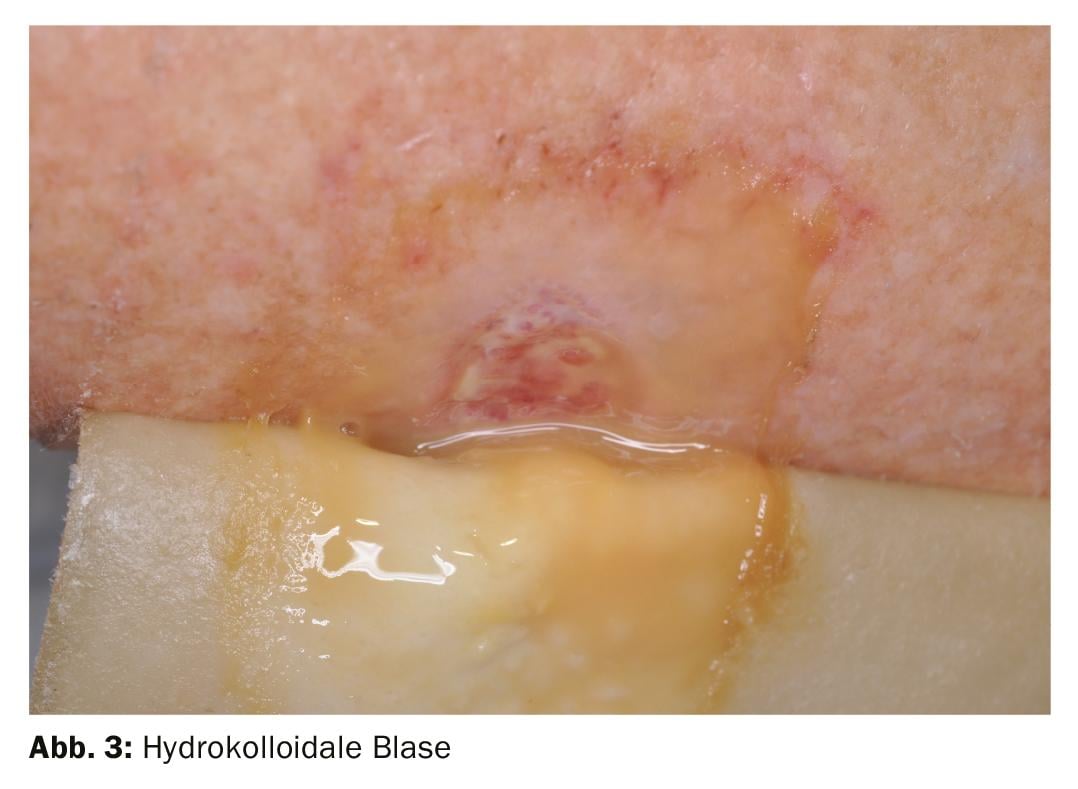 Como Tratar Úlceras: Opções e Recomendações Médicas
