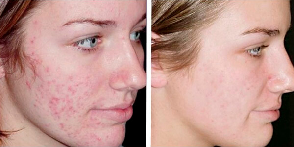 Resultados Reais: Antes e Depois do Peeling de Diamante para Cicatrizes de Acne