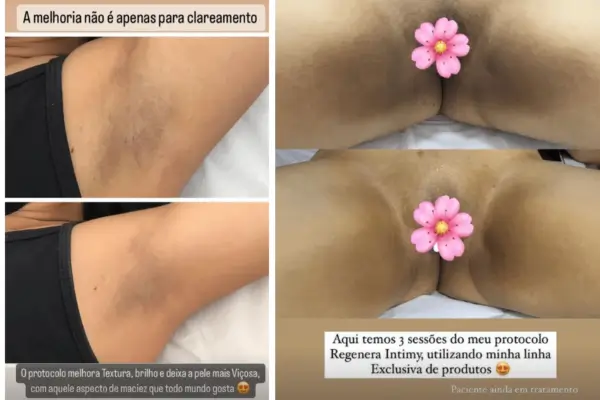 Ácido Mandélico: O Segredo para um Clareamento Íntimo Suave e Eficaz