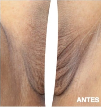 Laser e Microagulhamento: Como Potencializar os Resultados do seu Peeling Íntimo