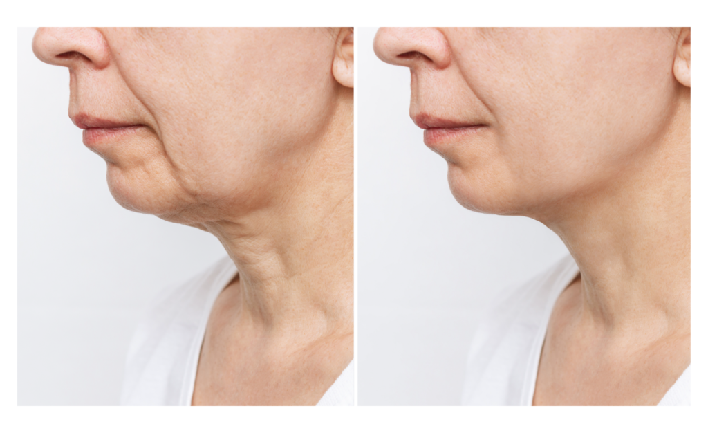 procedimentos para pescoço e colo