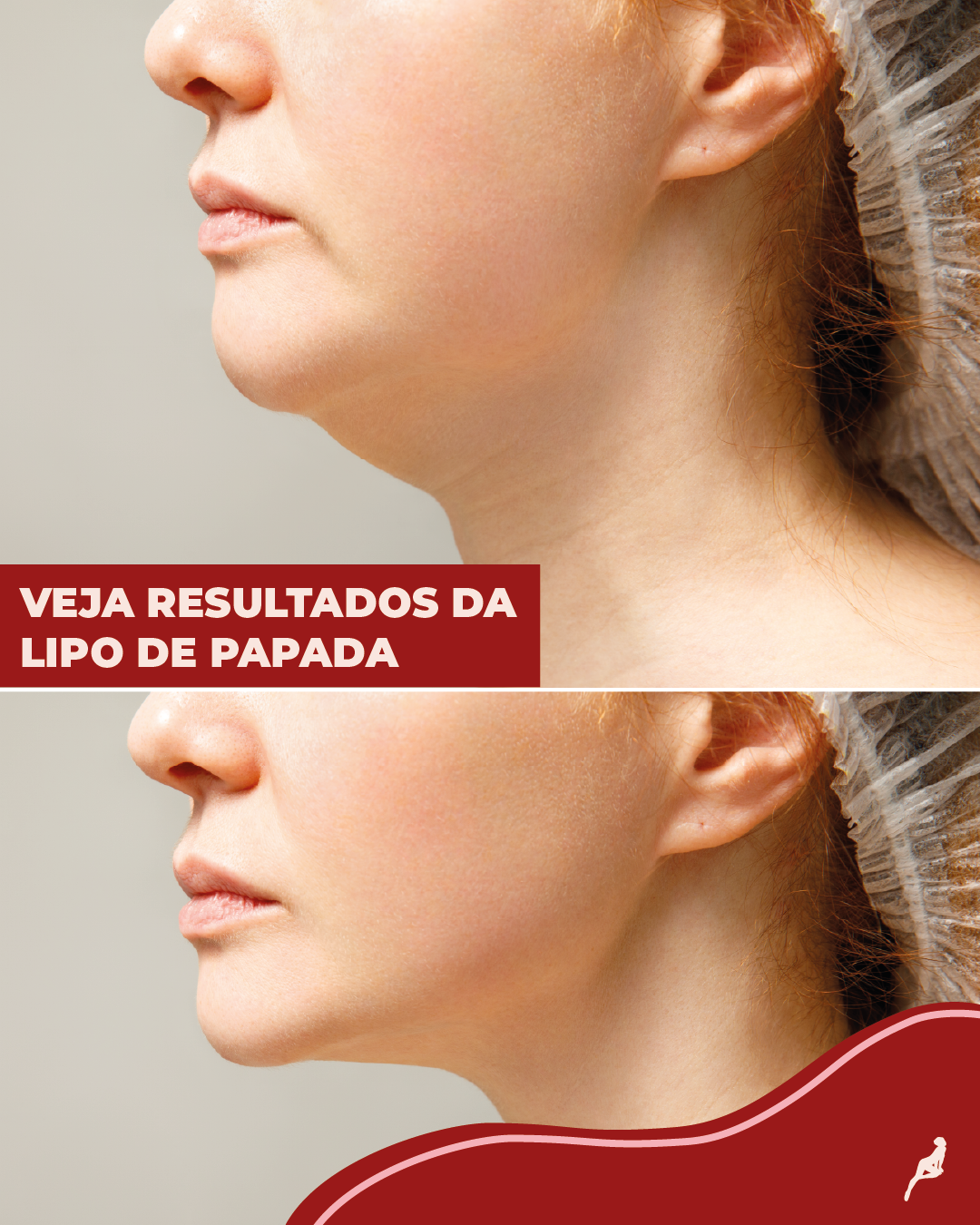 quanto custa procedimento para papada