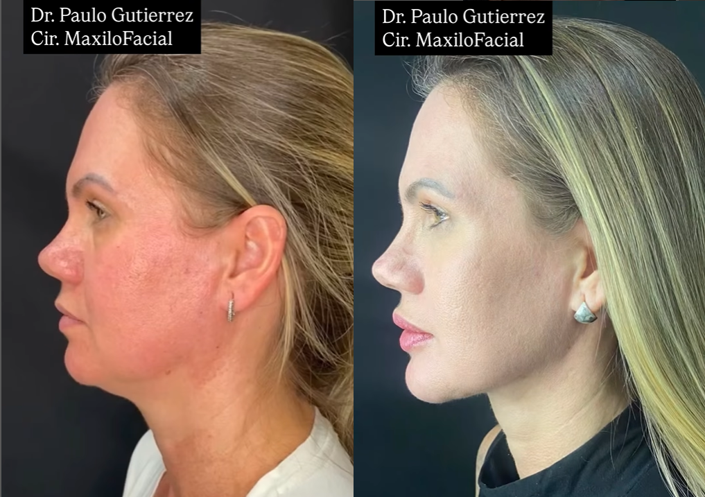 melhores tratamentos para papada sem cirurgia