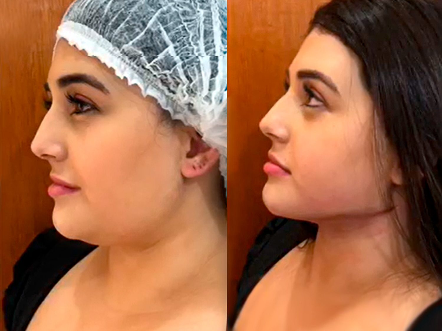 riscos e efeitos colaterais lipo de papada enzimática