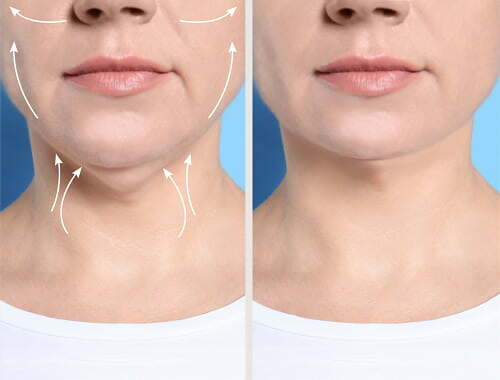 melhores tratamentos flacidez pescoço sem cirurgia