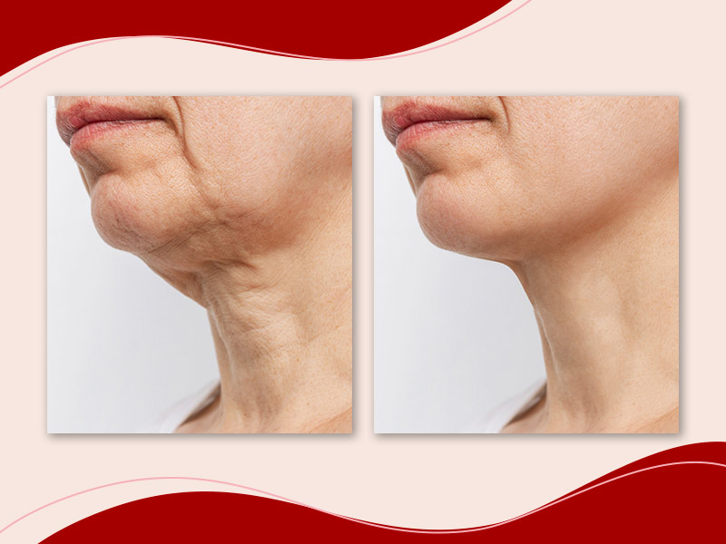 erros comuns tratamento flacidez pescoço