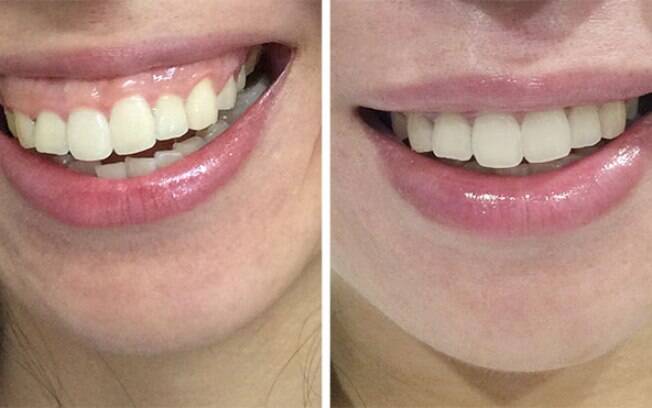 botox para sorriso gengival