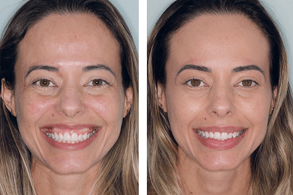 melhores momentos para aplicar botox sorriso gengival