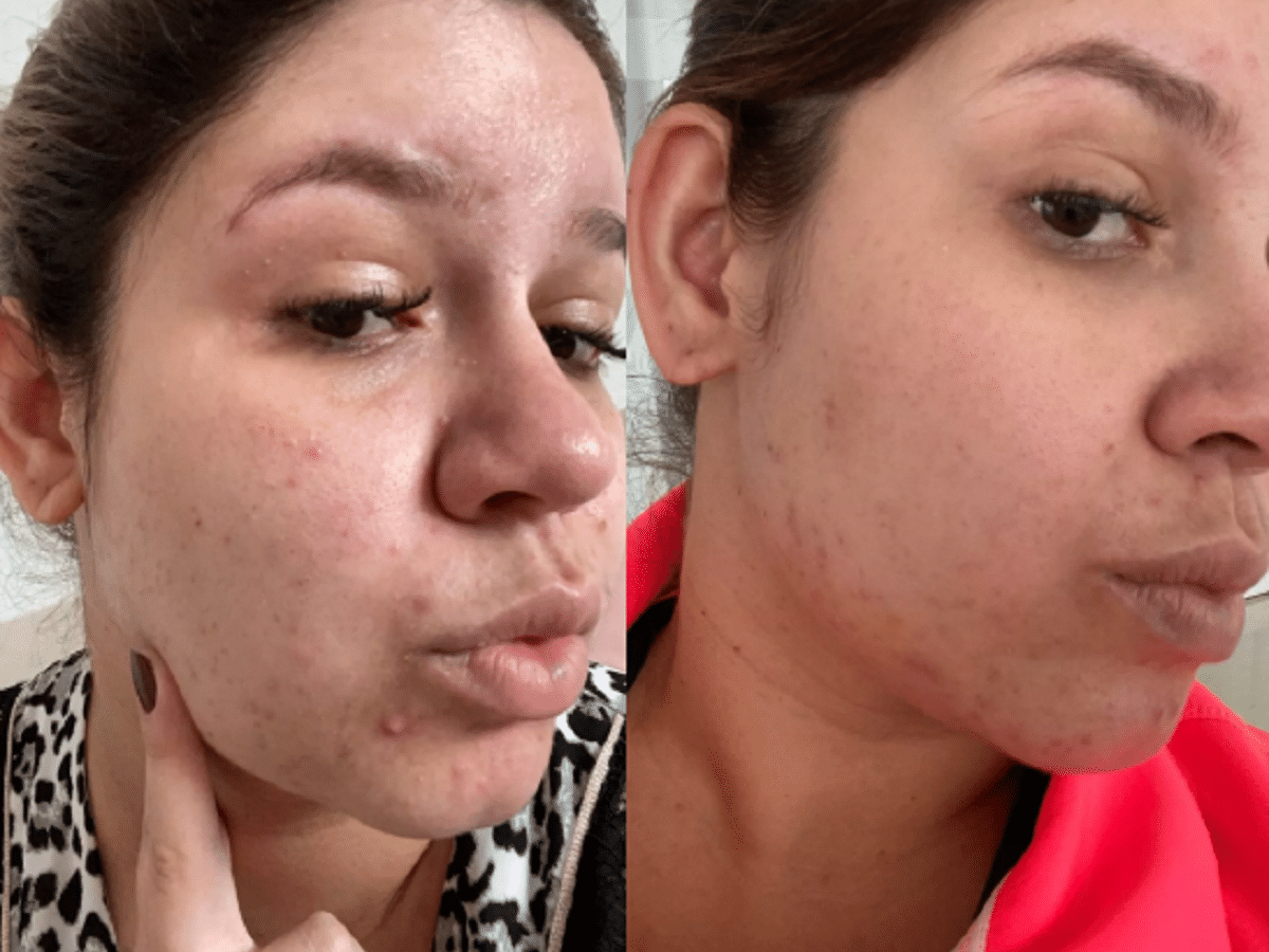 melhores sabonetes para espinha na gravidez