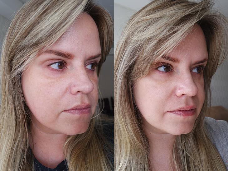 melhores resultados ultrassom microfocado antes e depois