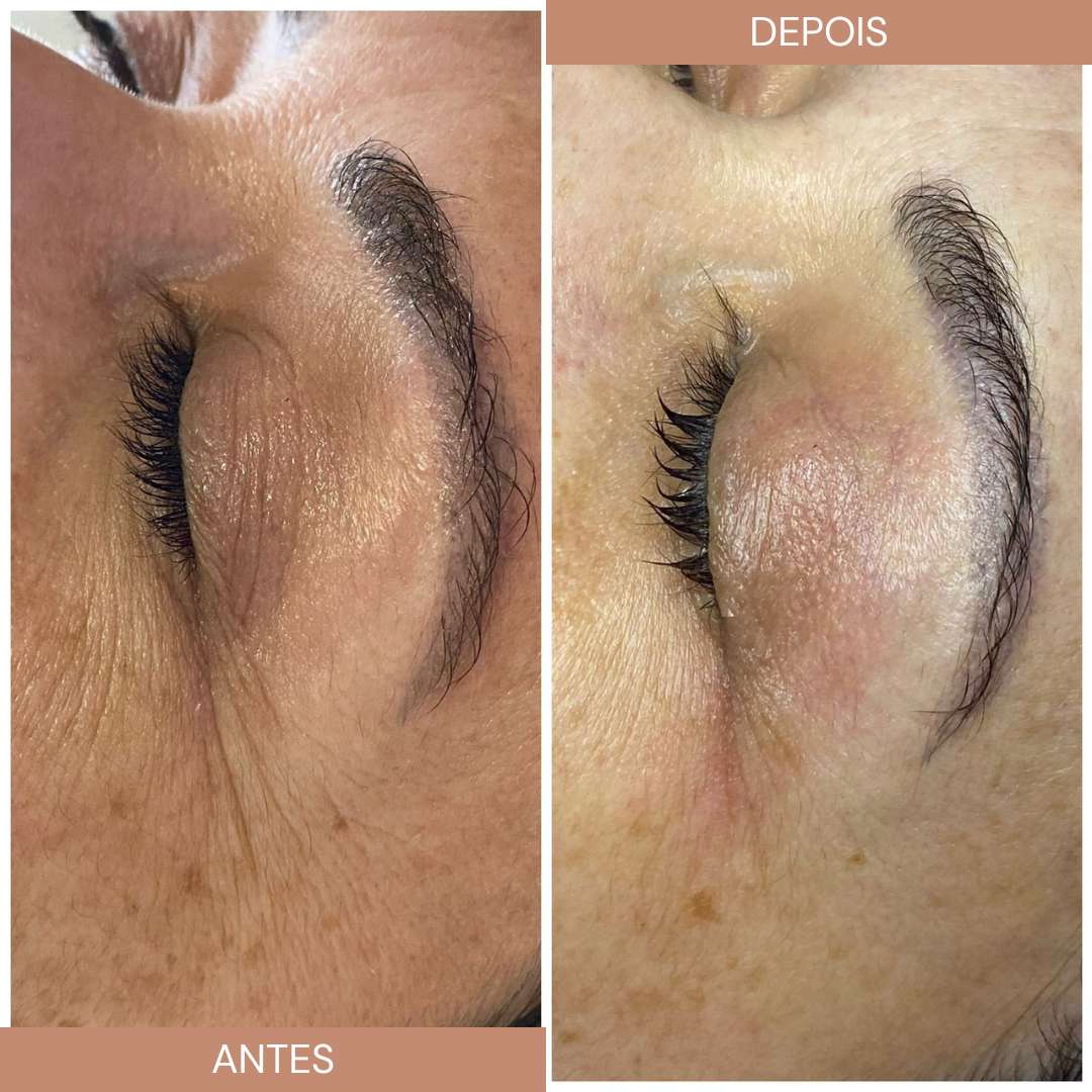 ultrassom microfocado erros comuns a evitar