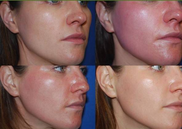 microagulhamento riscos e efeitos colaterais