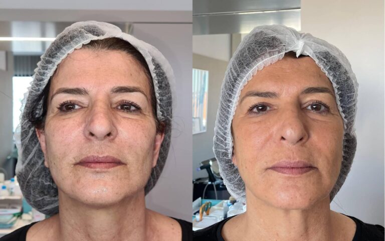 benefícios e riscos microagulhamento vale a pena