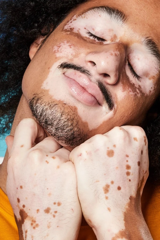 vitiligo em crianças fotos