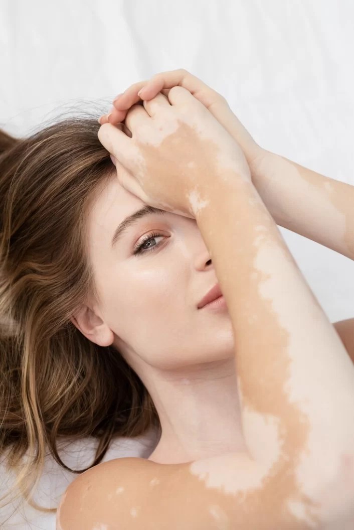 vitiligo piora com sol