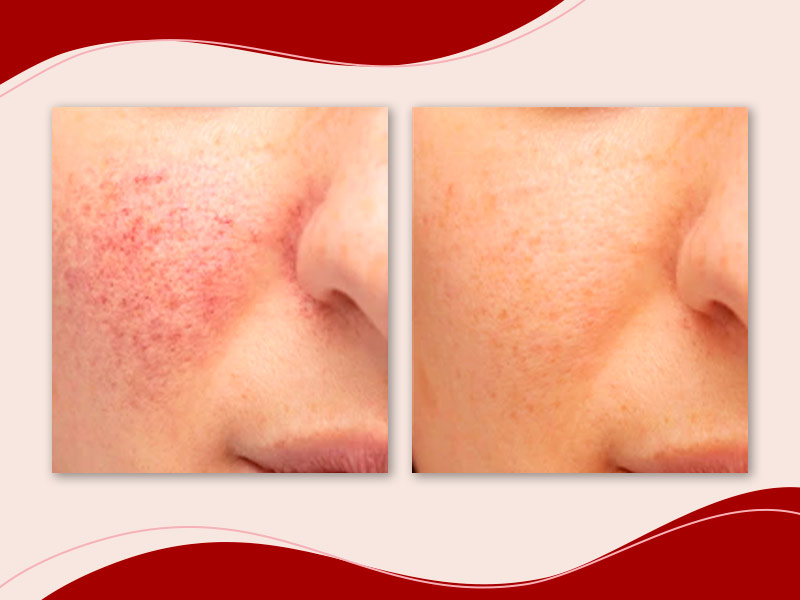 melhores resultados microagulhamento