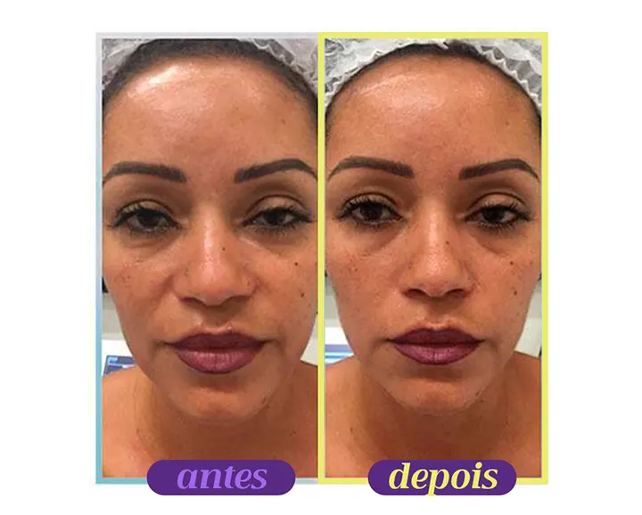 melhores resultados ultrassom microfocado antes e depois