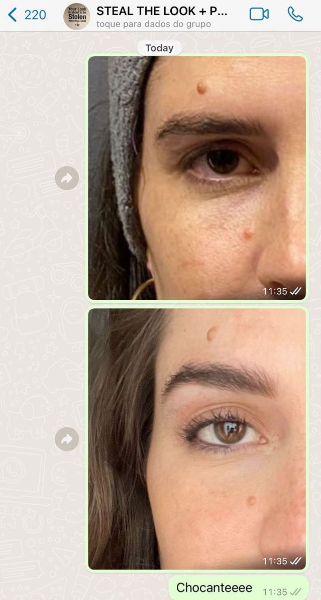 melhores tratamentos para pálpebras flácidas sem cirurgia