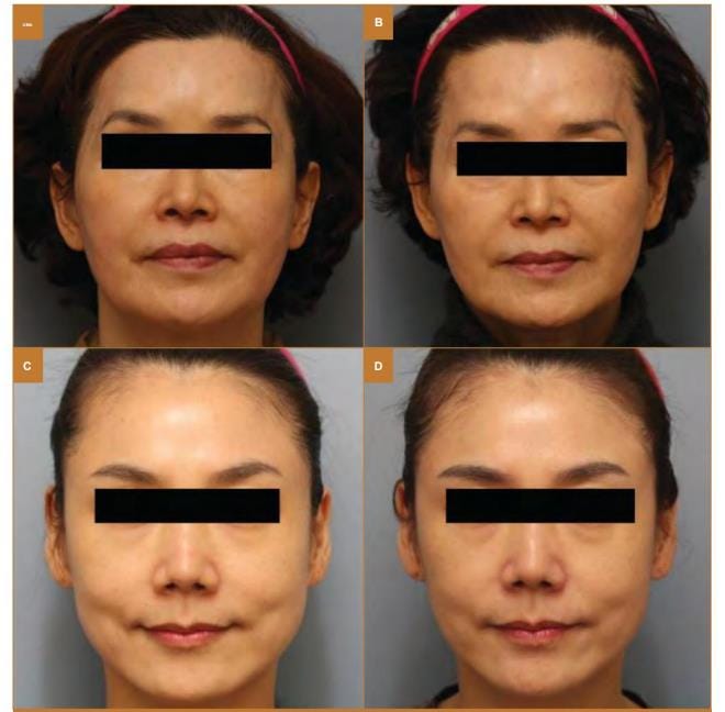 ultrassom microfocado riscos efeitos colaterais