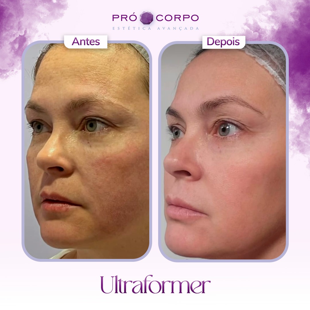 ultrassom microfocado vs ultraformer mpt qual melhor