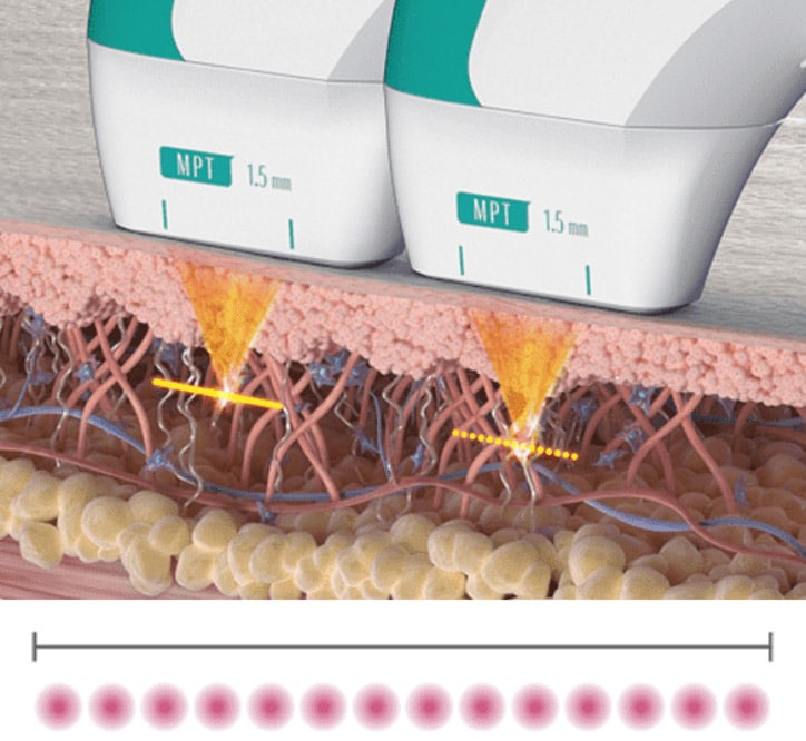 melhores tratamentos para flacidez sem cirurgia